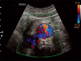 Colour Doppler ultrasound for blood flow imaging