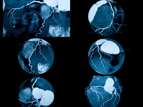 CT Coronary Angiography Heart Scan at Usmanpura Imaging Center